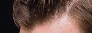 Hair Grow Max - effetti collaterali - controindicazioni