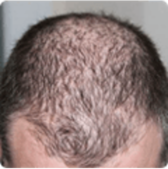 Grow Hair Active - effetti collaterali - controindicazioni