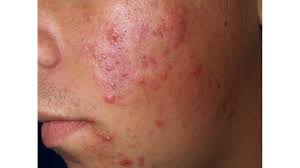 Skin Lifter - effetti collaterali - controindicazioni